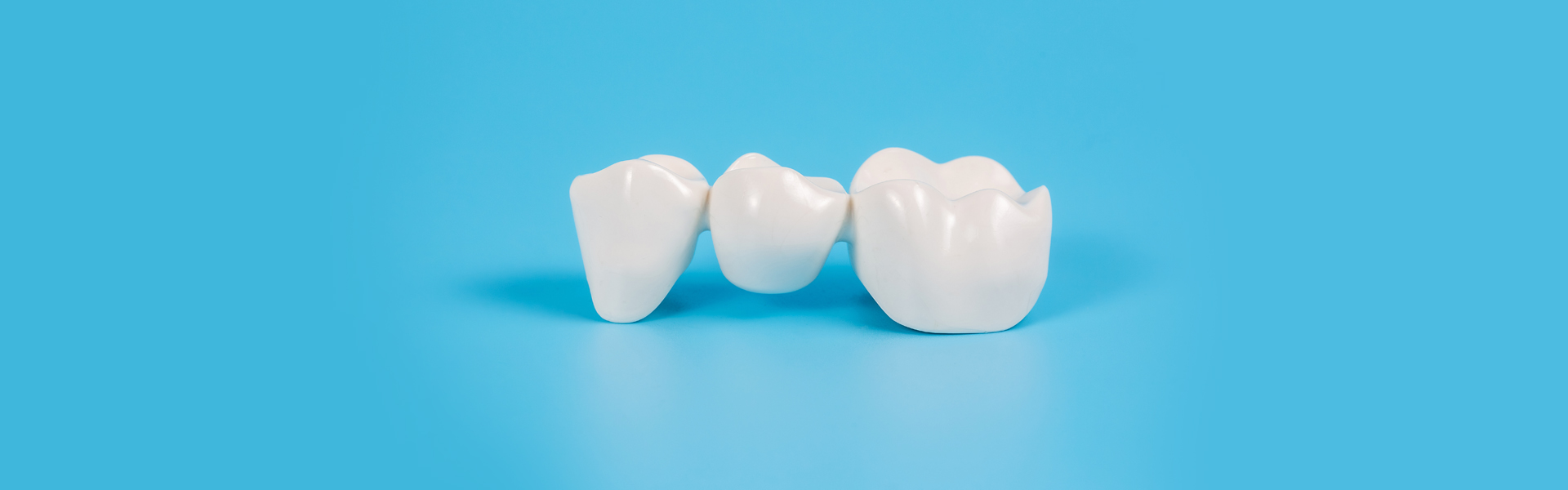 Five Things to Know Before Considering a Dental Bridge